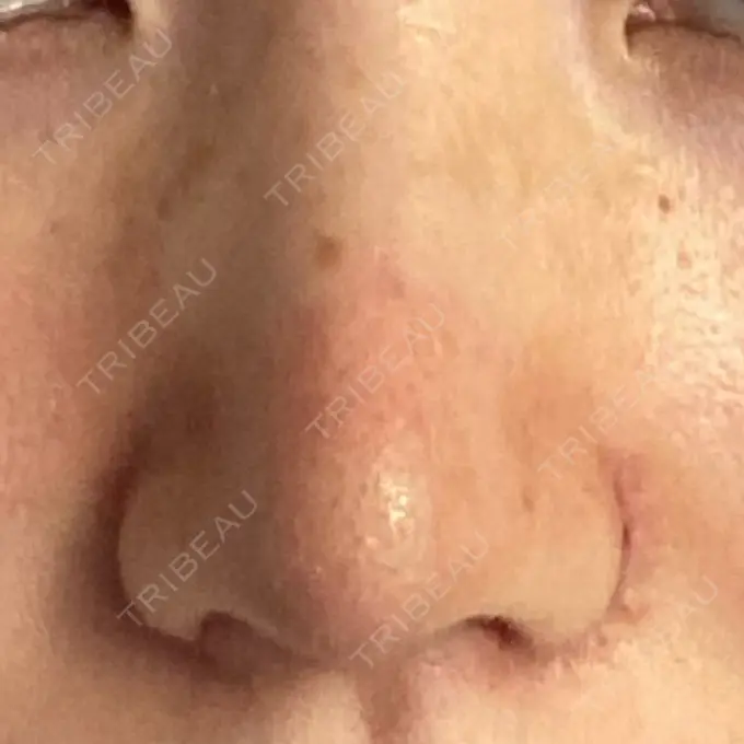 鼻尖形成（切開） / 小鼻縮小（切開） / 軟骨移植 麹町皮ふ科・形成外科クリニック DAY 10 メイン用