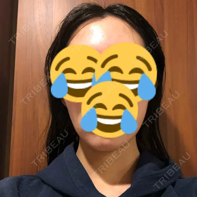 脂肪吸引（顔） THE CLINIC（ザ・クリニック） 東京院 DAY 64 メイン用