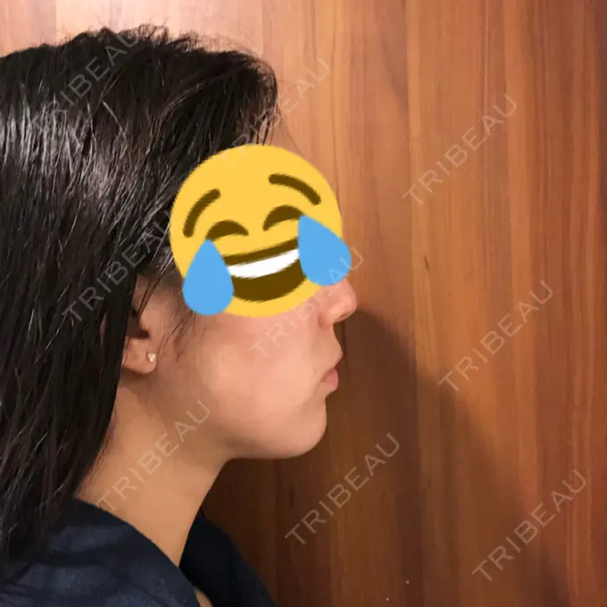 脂肪吸引（顔） THE CLINIC（ザ・クリニック） 東京院 DAY 64 メイン用