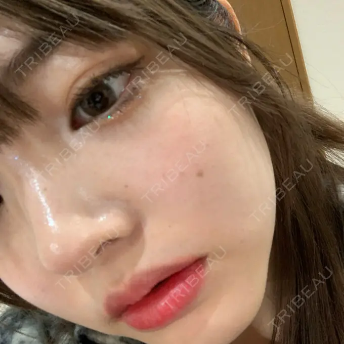 エレクトロポレーション / 毛穴洗浄（ハイドラフェイシャルなど） AURORA CLINIC（オーロラクリニック）新宿院 DAY 0 メイン用