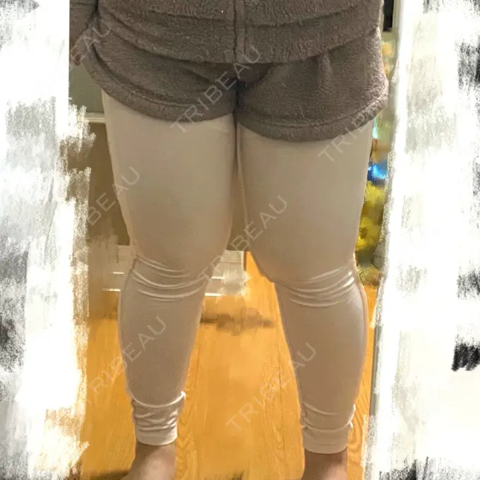 脂肪吸引（脚） THE CLINIC（ザ・クリニック） 名古屋院 DAY 0 メイン用