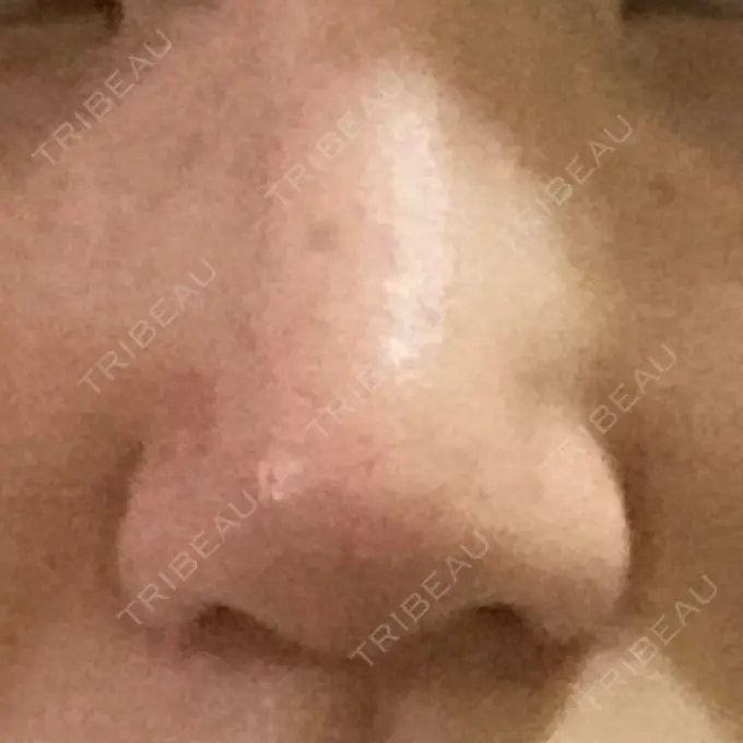 鼻尖形成（切開） / 小鼻縮小（切開） / 軟骨移植 麹町皮ふ科・形成外科クリニック AFTER メイン用