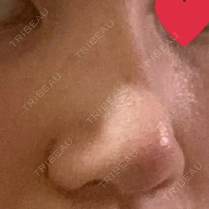 鼻尖形成（切開） / 小鼻縮小（切開） / 軟骨移植 麹町皮ふ科・形成外科クリニック DAY 16 メイン用