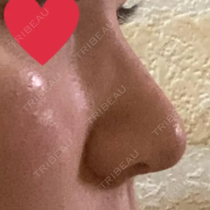 鼻尖形成（切開） / 小鼻縮小（切開） / 軟骨移植 麹町皮ふ科・形成外科クリニック DAY 16 メイン用