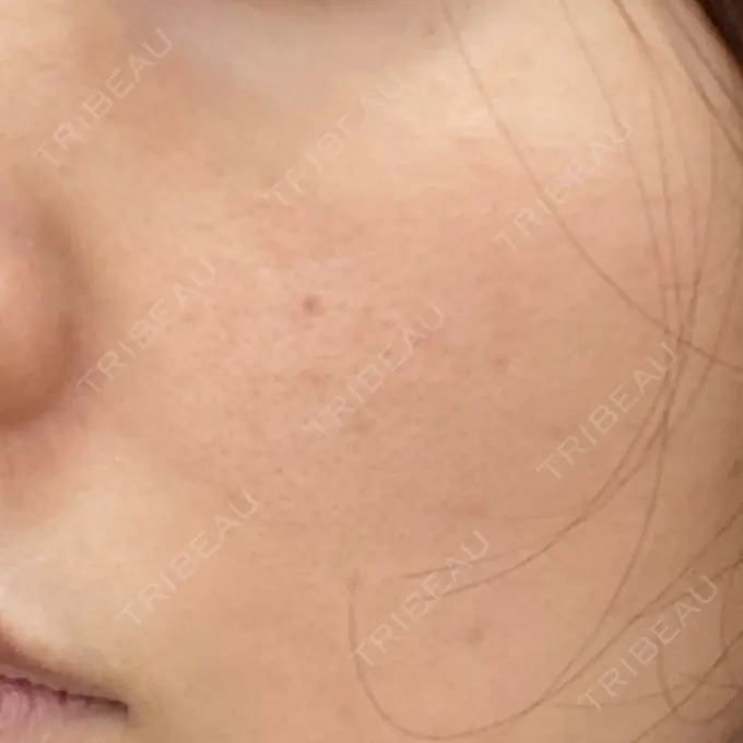 イオン導入 / 美肌レーザー / シミ取りレーザー / エレクトロポレーション 湘南美容クリニック 秋葉原院 AFTER メイン用