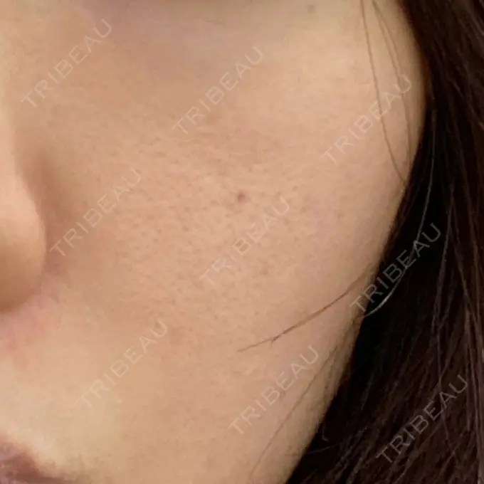 イオン導入 / 美肌レーザー / シミ取りレーザー / エレクトロポレーション 湘南美容クリニック 秋葉原院 DAY 594 メイン用