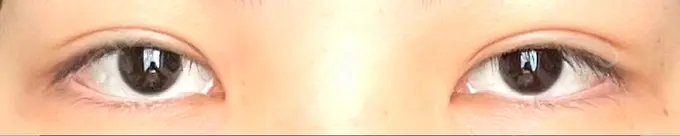 二重埋没 銀座S美容・形成外科クリニック DAY 21 メイン用