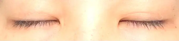 二重埋没 銀座S美容・形成外科クリニック DAY 21 メイン用