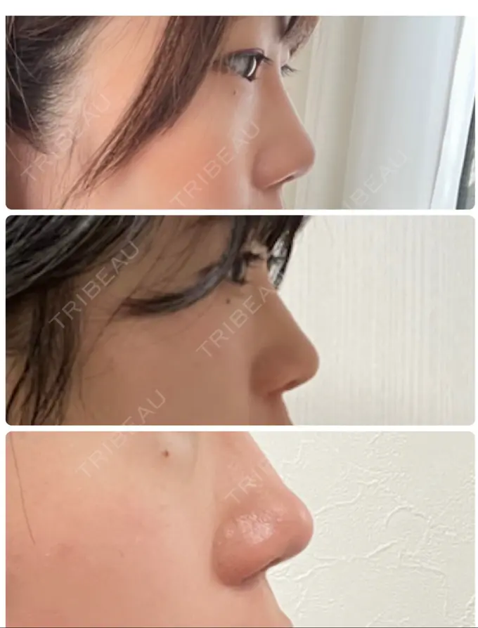 軟骨移植 / 鼻尖縮小 みずほクリニック AFTER メイン用