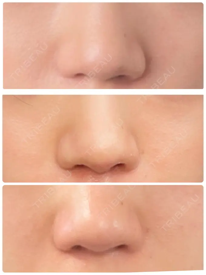 軟骨移植 / 鼻尖縮小 みずほクリニック DAY 60 メイン用