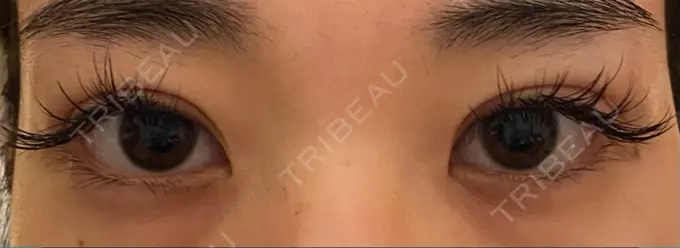 二重切開 / 上まぶたの脂肪取り 心斎橋コムロ美容外科クリニック DAY 42 メイン用