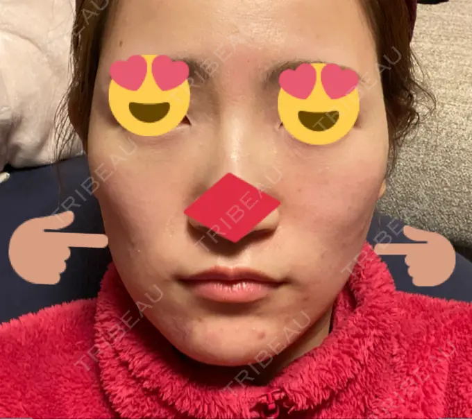 フォトRF リアルクリニック（REAL CLINIC） DAY 0 メイン用