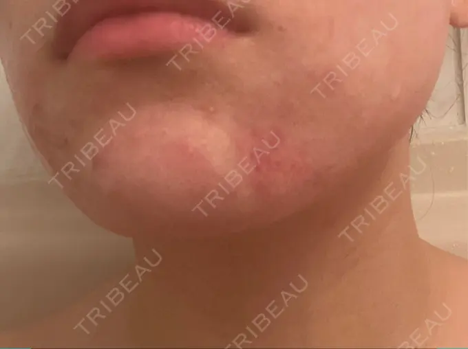 フォトRF リアルクリニック（REAL CLINIC） DAY 0 メイン用