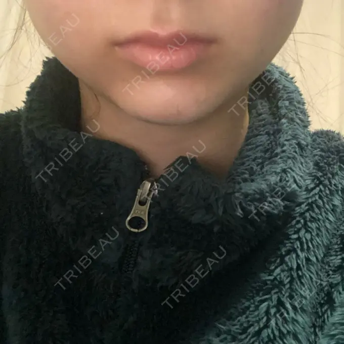 ボトックス（エラ・小顔） / その他（輪郭） もとび美容外科クリニック 新宿院 DAY 1 メイン用