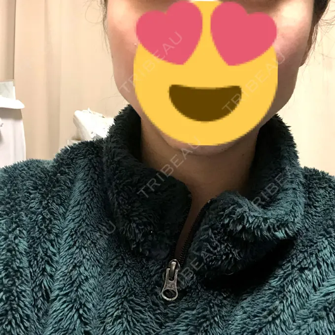 ボトックス（エラ・小顔） / その他（輪郭） もとび美容外科クリニック 新宿院 DAY 2 メイン用