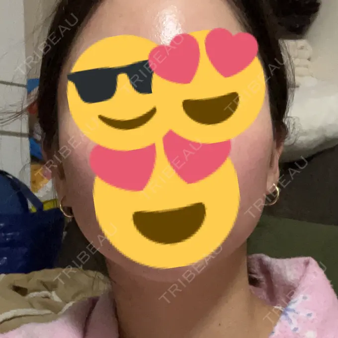 ボトックス（エラ・小顔） / その他（輪郭） もとび美容外科クリニック 新宿院 AFTER メイン用