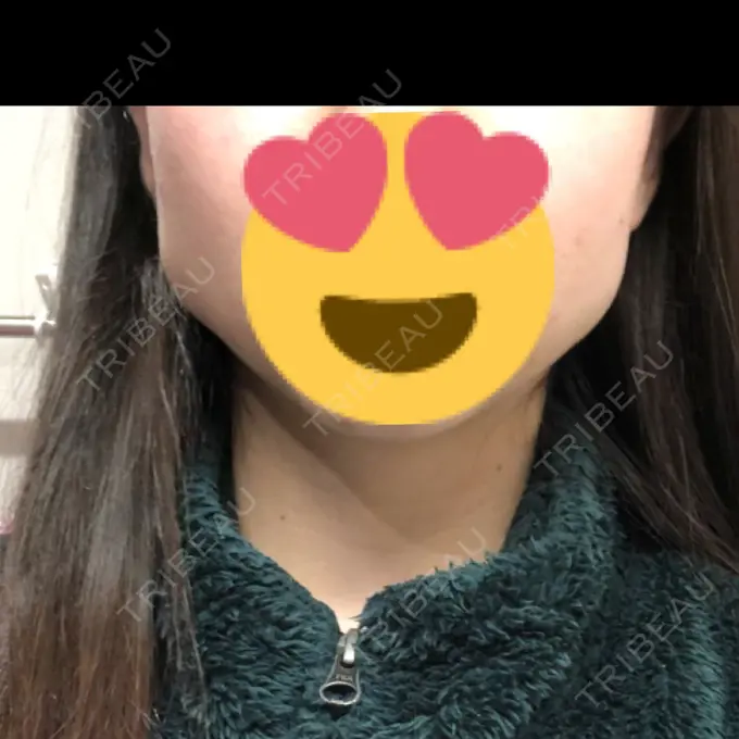 ボトックス（エラ・小顔） / その他（輪郭） もとび美容外科クリニック 新宿院 DAY 3 メイン用