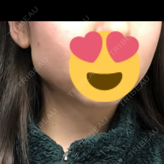 ボトックス（エラ・小顔） / その他（輪郭） もとび美容外科クリニック 新宿院 DAY 3 メイン用