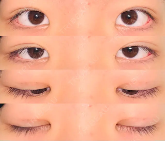 二重埋没 水の森美容クリニック 東京新宿院 DAY 31 メイン用