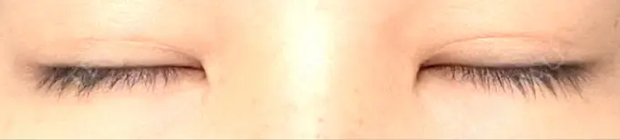 二重埋没 銀座S美容・形成外科クリニック DAY 31 メイン用