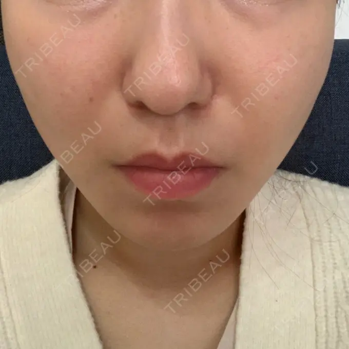 糸リフト / 脂肪吸引（顔） / メーラーファット除去 / ボトックス（エラ・小顔） 湘南美容クリニック 秋葉原院 DAY 256 メイン用