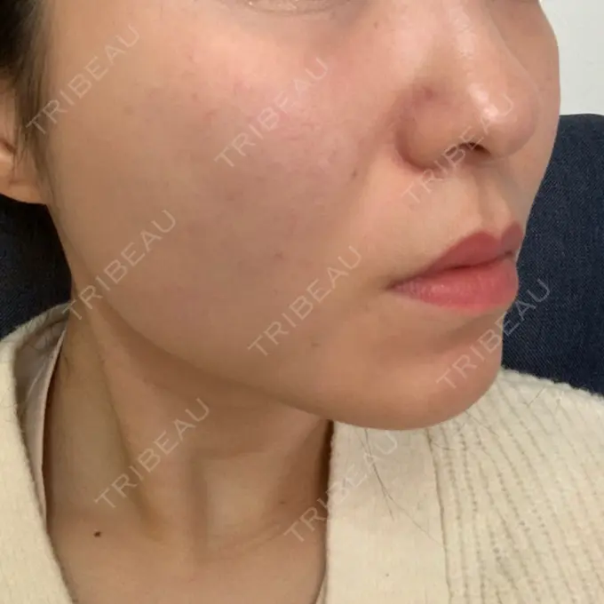 糸リフト / 脂肪吸引（顔） / メーラーファット除去 / ボトックス（エラ・小顔） 湘南美容クリニック 秋葉原院 DAY 256 メイン用