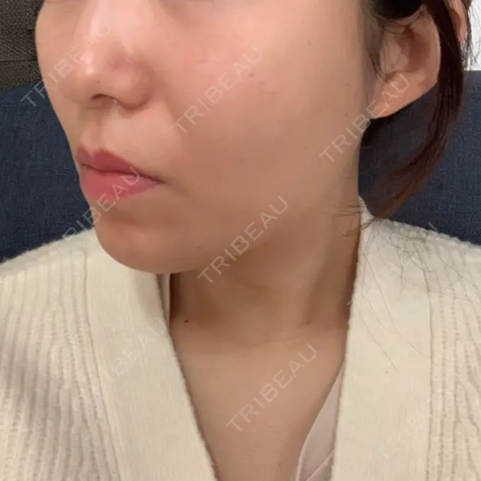 糸リフト / 脂肪吸引（顔） / メーラーファット除去 / ボトックス（エラ・小顔） 湘南美容クリニック 秋葉原院 DAY 256 メイン用