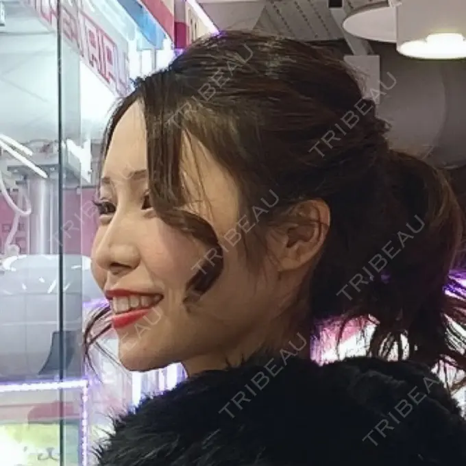 糸リフト / あごプロテーゼ / 脂肪吸引（顔） 湘南美容クリニック 上野院 AFTER メイン用