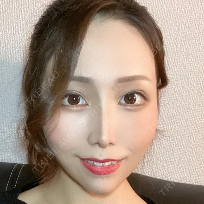 糸リフト / あごプロテーゼ / 脂肪吸引（顔） 湘南美容クリニック 上野院 DAY 81 メイン用