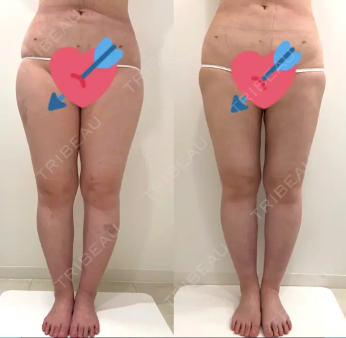 脂肪吸引（脚） / インディバ（お腹） 藤・ナチュレ美容クリニック 恵比寿院 DAY 91 メイン用