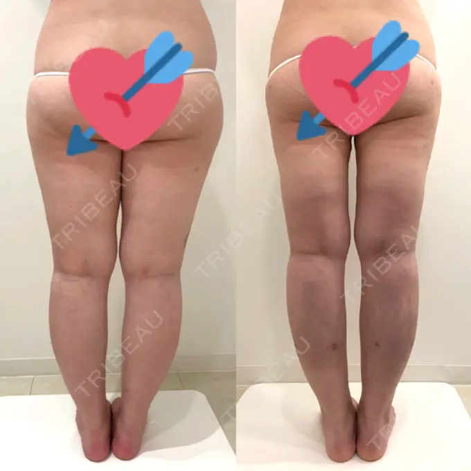 脂肪吸引（脚） / インディバ（お腹） 藤・ナチュレ美容クリニック 恵比寿院 DAY 91 メイン用