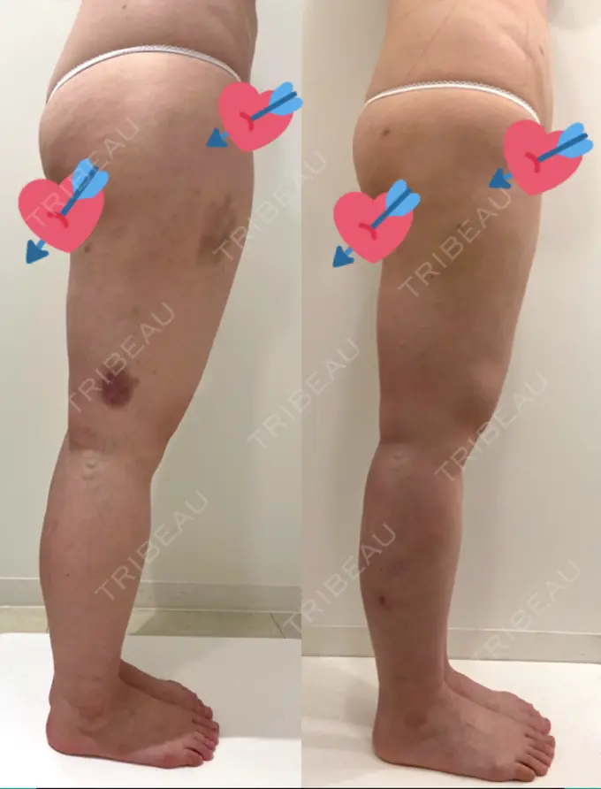 脂肪吸引（脚） / インディバ（お腹） 藤・ナチュレ美容クリニック 恵比寿院 DAY 91 メイン用