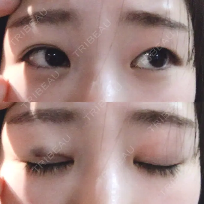 二重埋没 城本クリニック 福岡院 AFTER メイン用