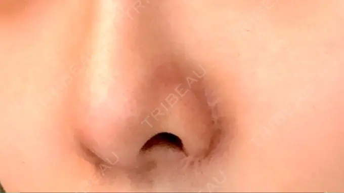 小鼻縮小（切開） / 軟骨移植 / 鼻尖縮小 麹町皮ふ科・形成外科クリニック AFTER メイン用