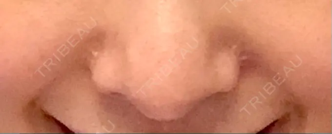 小鼻縮小（切開） / 軟骨移植 / 鼻尖縮小 麹町皮ふ科・形成外科クリニック DAY 332 メイン用