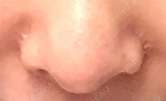 小鼻縮小（切開） / 軟骨移植 / 鼻尖縮小 麹町皮ふ科・形成外科クリニック DAY 332 メイン用