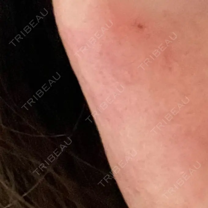 毛穴洗浄（ハイドラフェイシャルなど） / ピーリング（ハリ・ツヤ） 表参道メディカルクリニック 福岡天神院 AFTER メイン用