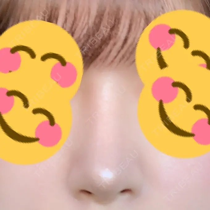 隆鼻術 / 軟骨移植 / プロテーゼ除去 FROM B整形外科 (旧バウム整形外科) DAY 200 メイン用