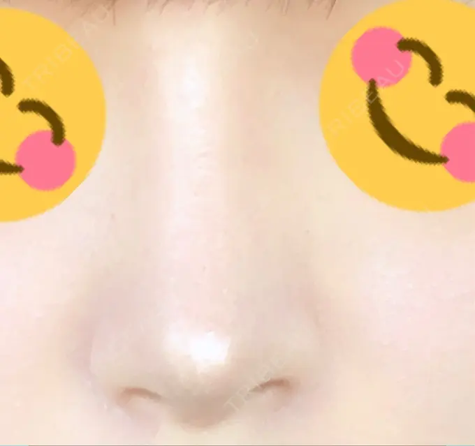 隆鼻術 / 軟骨移植 / プロテーゼ除去 FROM B整形外科 (旧バウム整形外科) DAY 200 メイン用