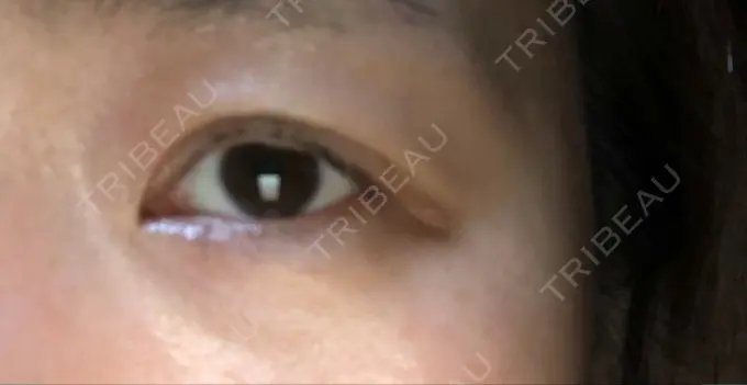 二重埋没 湘南美容クリニック 長野院 DAY 23 メイン用