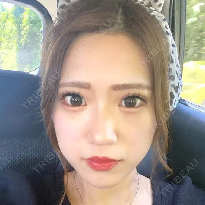 脂肪溶解注射（顔） 新宿美容外科クリニック 新宿院 DAY 2 メイン用