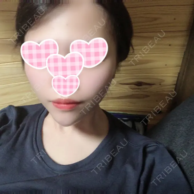 糸リフト / 脂肪吸引（顔） / メーラーファット除去 / ヒアルロン酸注入（あご） 藤・ナチュレ美容クリニック 恵比寿院 DAY 35 メイン用