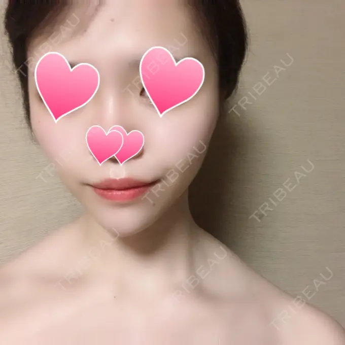 糸リフト / 脂肪吸引（顔） / メーラーファット除去 / ヒアルロン酸注入（あご） 藤・ナチュレ美容クリニック 恵比寿院 DAY 62 メイン用