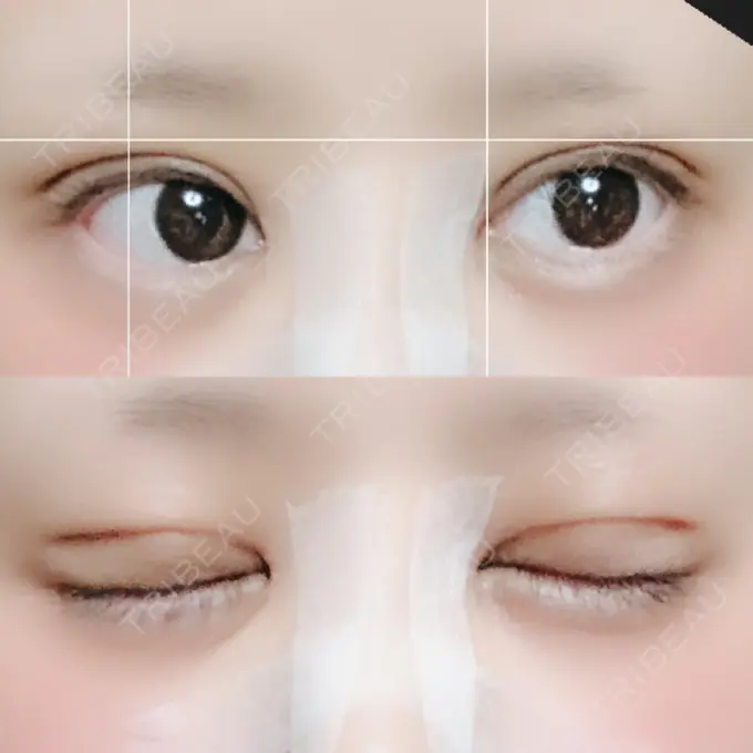 二重切開 / 目頭切開 / ヒアルロン酸注入（涙袋） FROM B整形外科 (旧バウム整形外科) DAY 29 メイン用