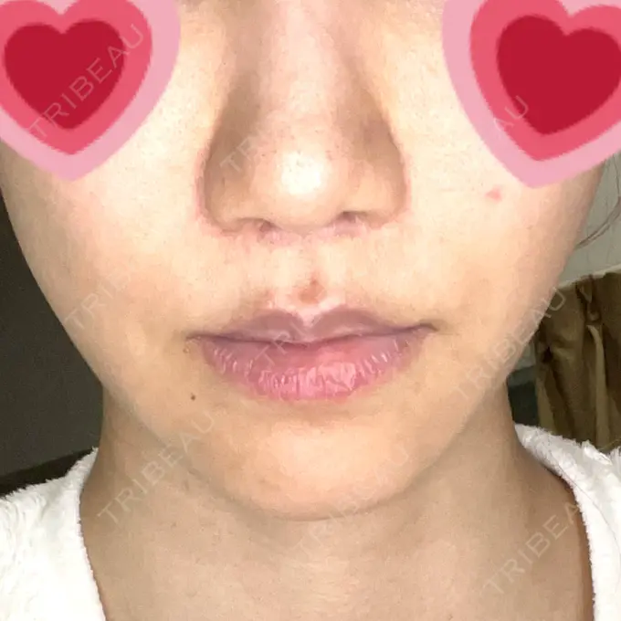 人中短縮 みずほクリニック AFTER メイン用