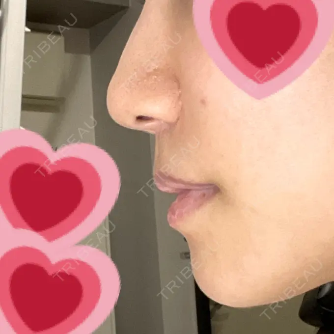 人中短縮 みずほクリニック DAY 255 メイン用