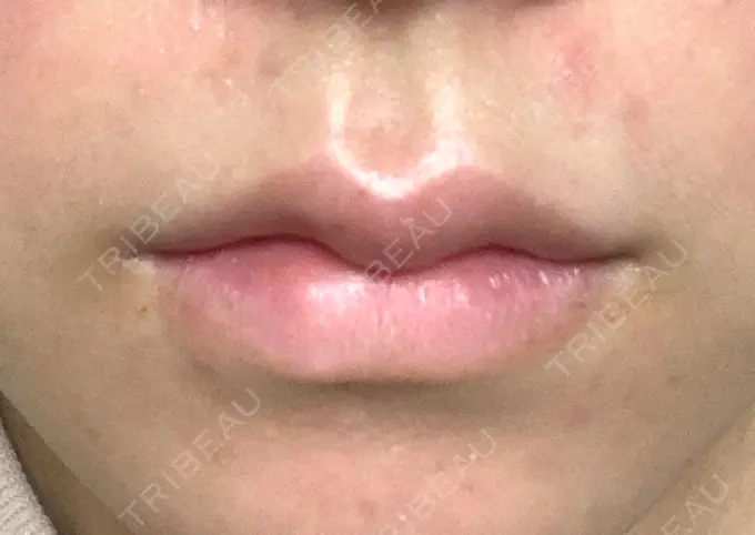 ヒアルロン酸注入（唇） YBC横浜美容外科 大宮院 AFTER メイン用