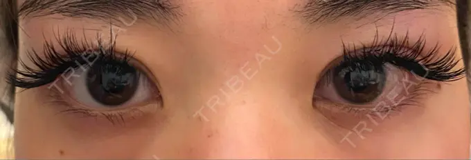 二重切開 / 上まぶたの脂肪取り 心斎橋コムロ美容外科クリニック DAY 62 メイン用