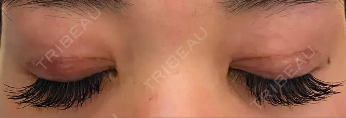 二重切開 / 上まぶたの脂肪取り 心斎橋コムロ美容外科クリニック DAY 62 メイン用