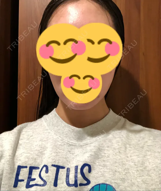 脂肪吸引（顔） THE CLINIC（ザ・クリニック） 東京院 AFTER メイン用